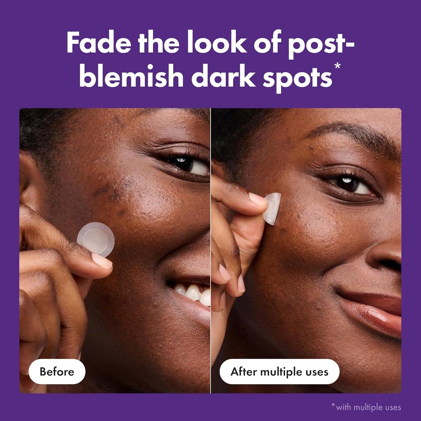 Hero Cosmetics Mighty Patch Micropoint Dark Spot Patches – Thoughtful Birthday Gift for Her, Brightening Skincare Surprise